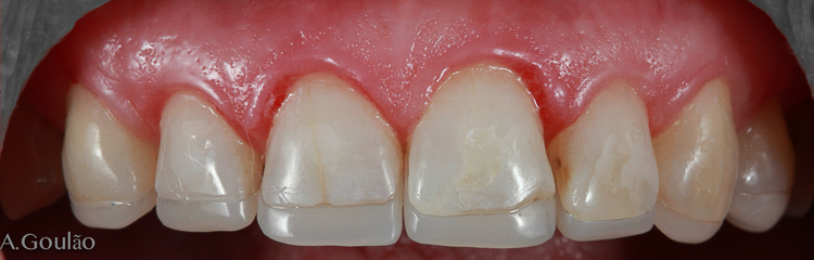 adesao palatinas.jpg