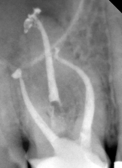 tratamento endodontico Dr Alexandre Goulão Dentarmed Almada