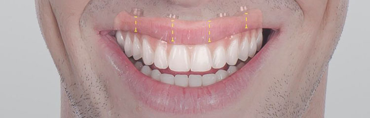 protese de carga imediata