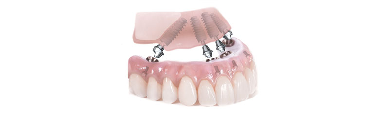 all on 4 implant