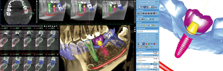 digital implant plan