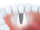 Quanto custa fazer tratamentos com implantes dentários?