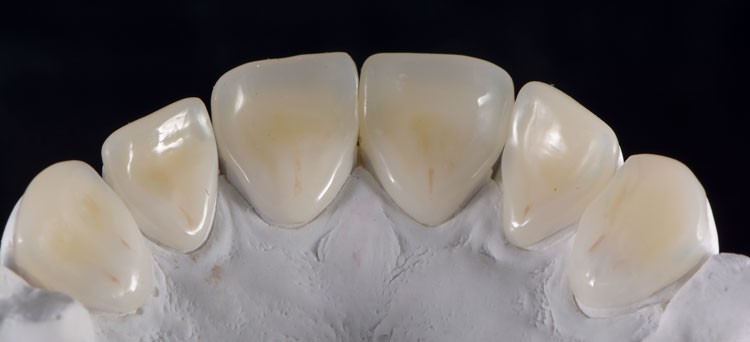 Labwork palatal veneers