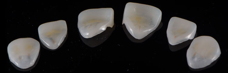 palatal veneers