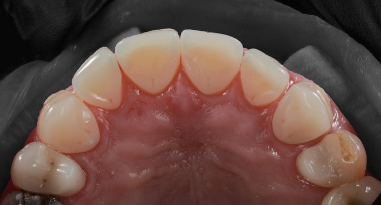 Palatal Venners Final - Lava Ultimate 