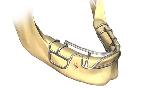 subperiosteal-dental-implants.jpg