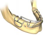 Implantes Dentários Híbridos Personalizados