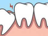 Com que idade os dentes do siso devem ser extraídos?